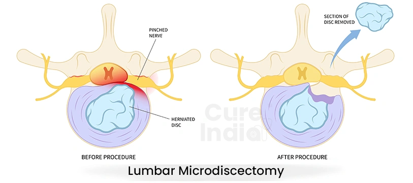 Lumbar Microdiscectomy Surgery in India